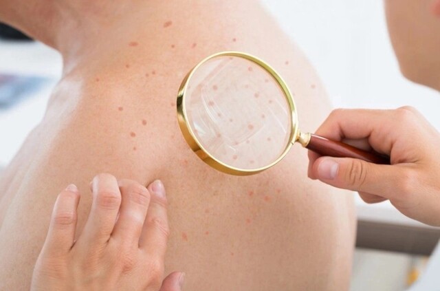 Bật mí những ý nghĩa thú vị của nốt ruồi son theo từng vị trí trên cơ thể Bật mí những ý nghĩa thú vị của nốt ruồi son theo từng vị trí trên cơ thể